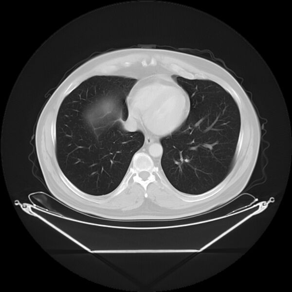 File:Bronchogenic carcinoma with upper lobe collapse (Radiopaedia 29297-29726 Axial lung window 24).jpg
