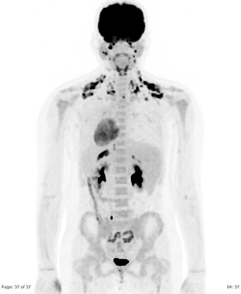 File:Brown fat uptake (FDG PET-CT) (Radiopaedia 77392-89513 MIP 36).jpg