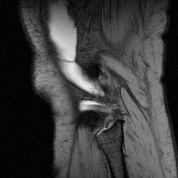 File:Bucket handle tear - medial meniscus (Radiopaedia 79028-91942 D 2).jpg