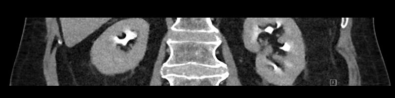 File:Buried bumper syndrome - gastrostomy tube (Radiopaedia 63843-72575 Coronal Inject 66).jpg