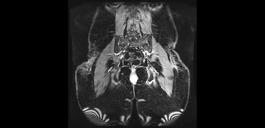 Buttock filler complications (Radiopaedia 63497-72115 Coronal T1 C+ 39).jpg