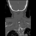 C1 anterior arch (plough) fracture - type 1 (Radiopaedia 76181-87720 Coronal bone window 9).jpg
