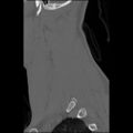 C5 facet fracture (Radiopaedia 58374-65499 Sagittal bone window 17).jpg