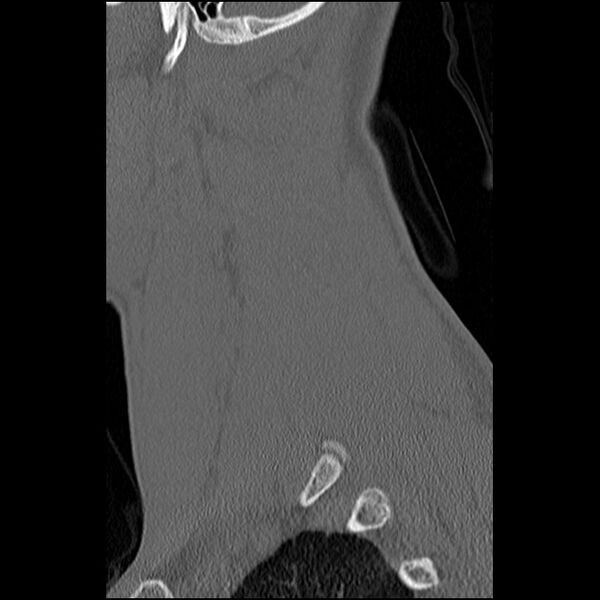 File:C5 facet fracture (Radiopaedia 58374-65499 Sagittal bone window 17).jpg