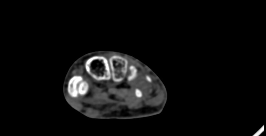 Calcifying aponeurotic fibroma (Radiopaedia 88423-105064 B 122).jpg
