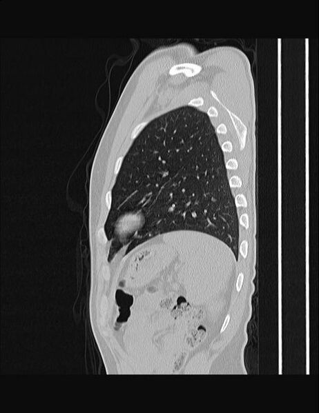 File:Calcifying pulmonary metastases (Radiopaedia 33359-34396 Sagittal lung window 14).jpg