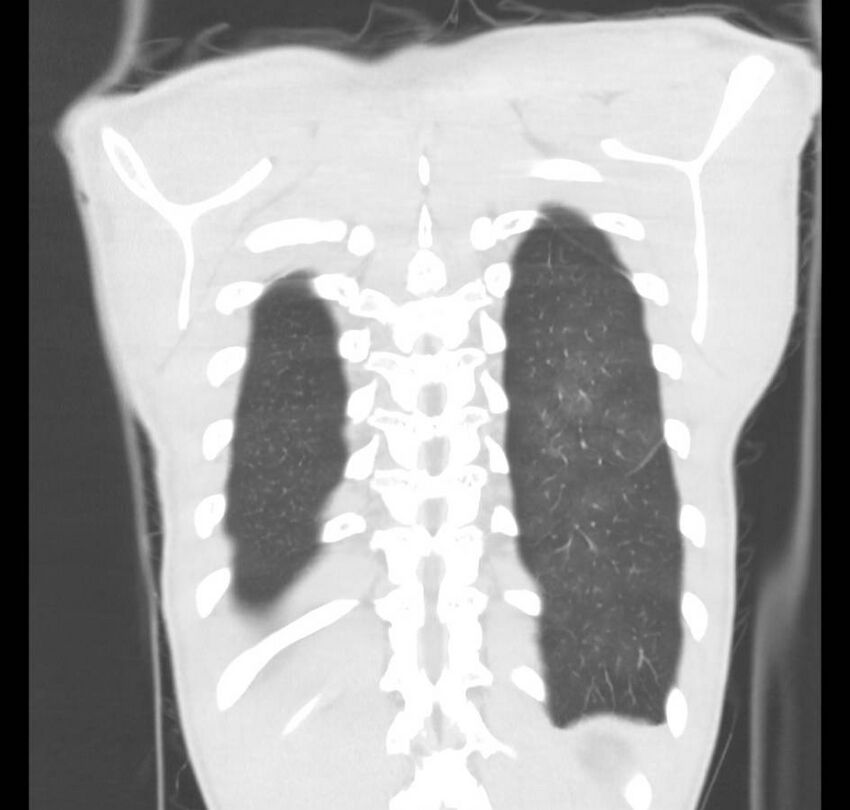 Cannabis-induced diffuse alveolar hemorrhage (Radiopaedia 89834-106946 Coronal lung window 10).jpg