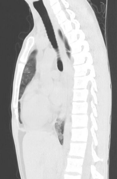 File:Cannabis-induced diffuse alveolar hemorrhage (Radiopaedia 89834-106946 Sagittal lung window 71).jpg