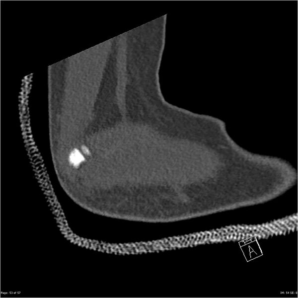 File:Capitellum fracture (Radiopaedia 23352-23426 Sagittal bone window 53).jpg