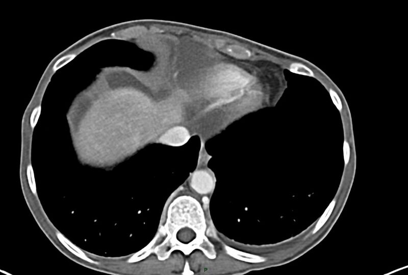 File:Carcinoid mesenteric tumor complicated by chylous ascites (Radiopaedia 76312-87953 A 4).jpg