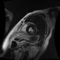 Cardiac fibroma (Radiopaedia 38974-41150 C 7).jpg