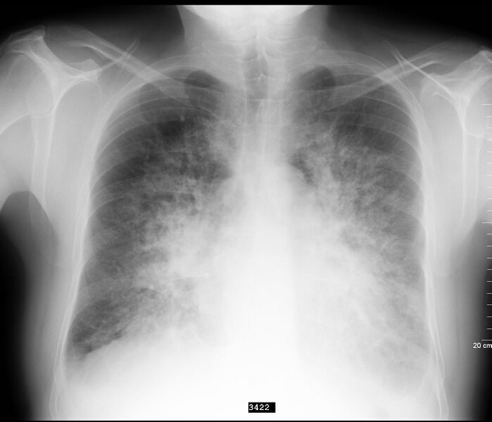 File:Cardiogenic pulmonary edema (Radiopaedia 48089).jpg