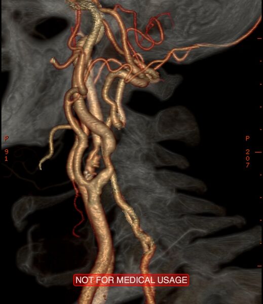 File:Carotid artery stenosis (Radiopaedia 28786-29086 A 5).jpg
