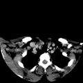 Carotid body tumor (Radiopaedia 27890-28124 A 29).jpg