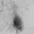 Carotid body tumor on angiography (Radiopaedia 4651-6729 A 6).jpg