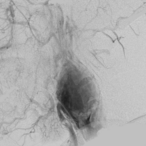 File:Carotid body tumor on angiography (Radiopaedia 4651-6729 A 6).jpg