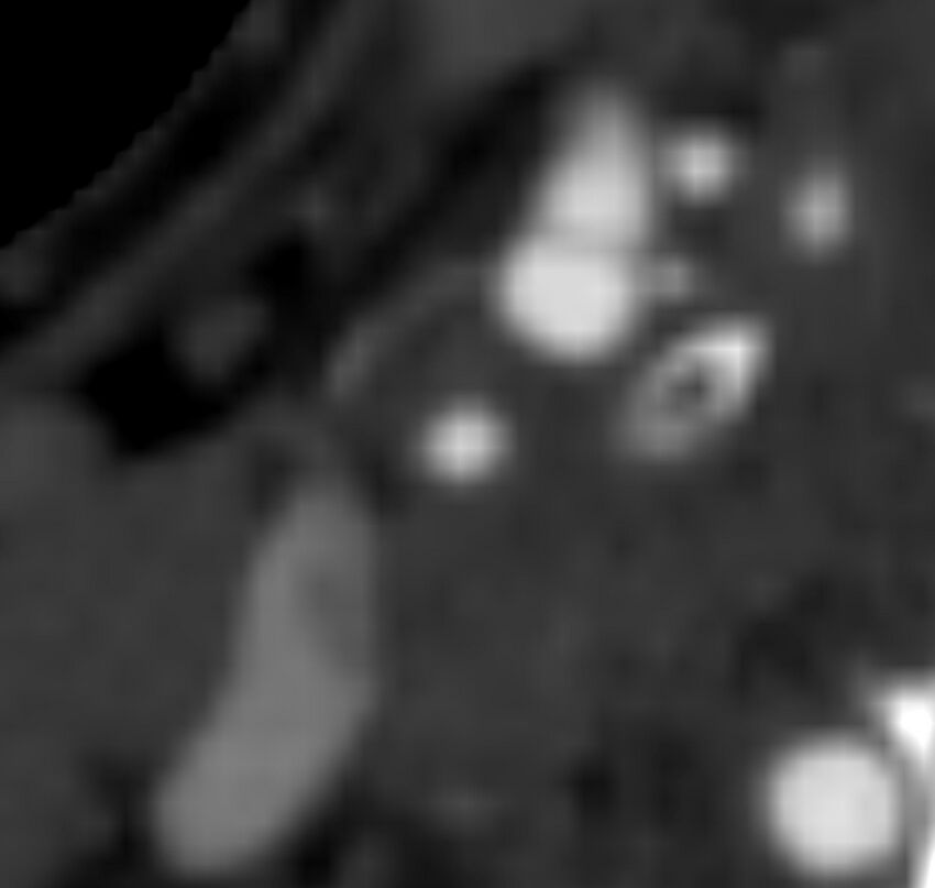 Carotid near-occlusion (Radiopaedia 85304-100887 M 71).jpg
