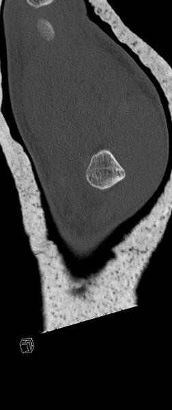 File:Carpal fractures (smart watch impaction) (Radiopaedia 55844-62430 Sagittal bone window 42).jpg