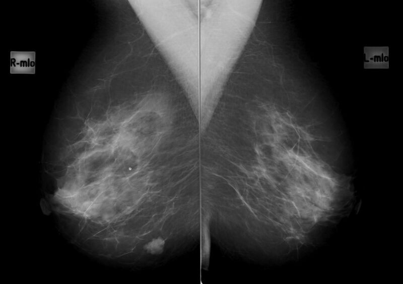 File:Cavernous hemangioma of the breast (Radiopaedia 34615-36001 MLO 1).jpg
