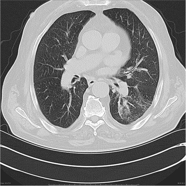 File:Cavitating left lower lobe lesion - squamous cell lung cancer (Radiopaedia 27749-28176 Axial lung window 26).jpg