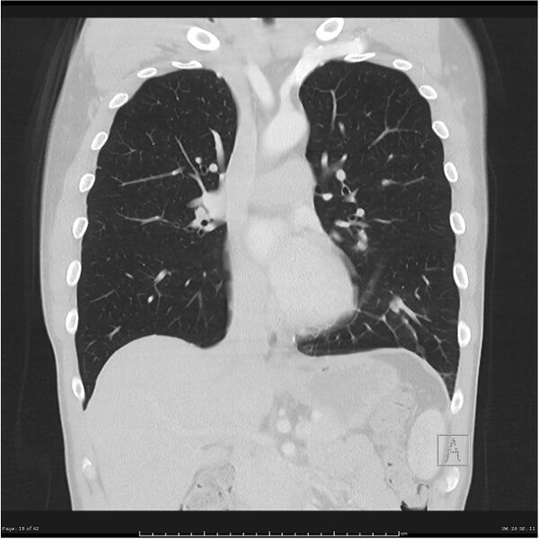 File:Cavitating lung cancer (Radiopaedia 25796-25945 lung window 18).jpg