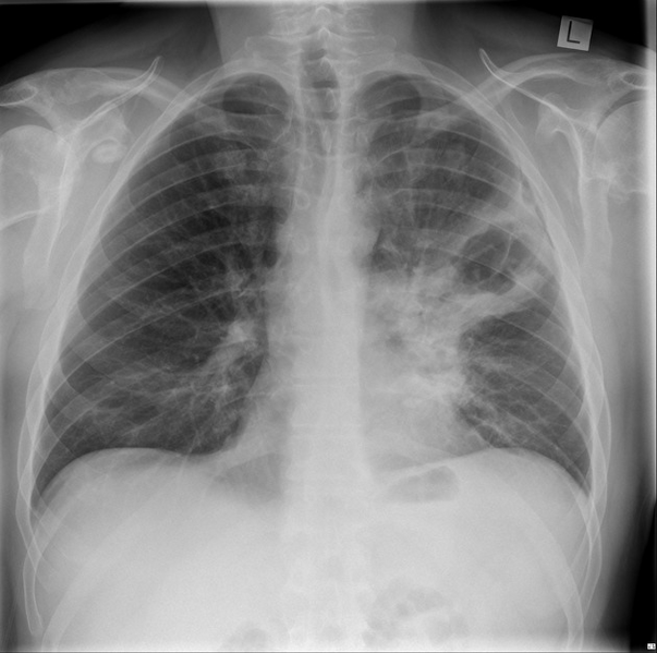 File:Cavitating pneumonia complicated by pneumothorax (Radiopaedia 48149-52993 Frontal 1).png