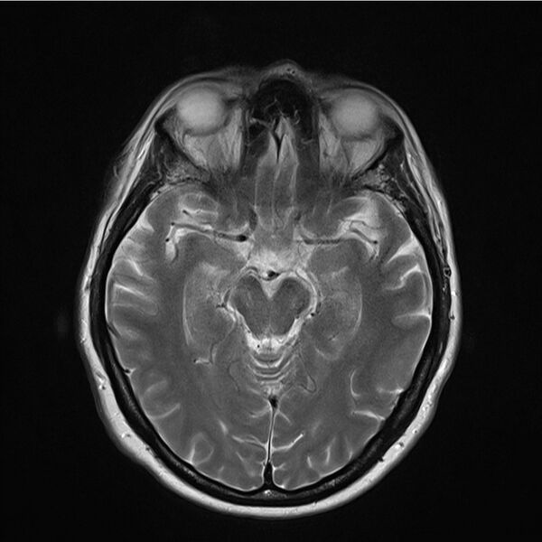 File:Central base of skull meningioma (Radiopaedia 53531-59549 Axial T2 9).jpg