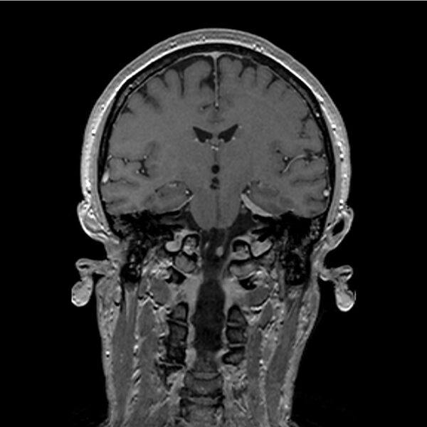 File:Central base of skull meningioma (Radiopaedia 53531-59549 Coronal T1 C+ 25).jpg