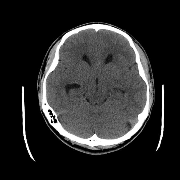 File:Central neurocytoma (Radiopaedia 79320-92379 Axial non-contrast 20).jpg
