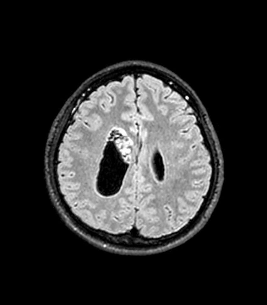 Central neurocytoma (Radiopaedia 79320-92380 Axial FLAIR 105).jpg
