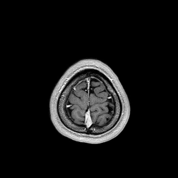 File:Central neurocytoma (Radiopaedia 79320-92380 Axial T1 C+ 213).jpg