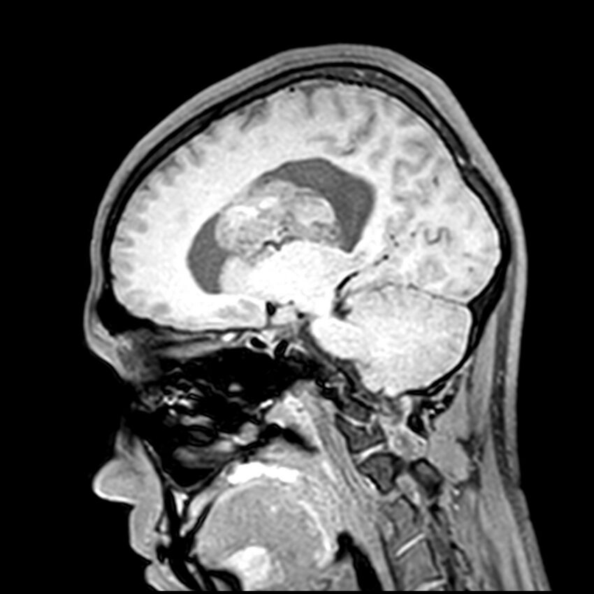 Central neurocytoma (Radiopaedia 79320-92380 Sagittal T1 154).jpg