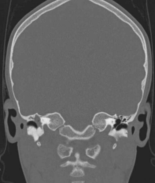 File:Cerebellar abscess (Radiopaedia 73727-84527 Coronal bone window 70).jpg