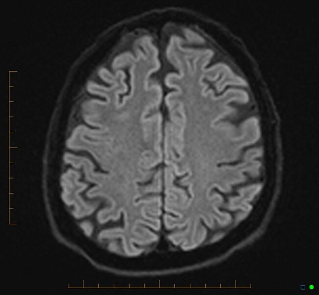 File:Cerebellar gangliocytoma (Radiopaedia 65377-74422 Axial DWI 29).jpg