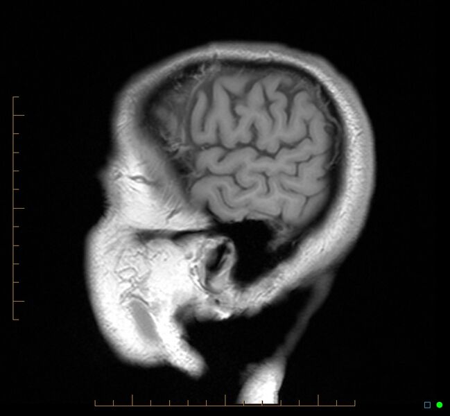 File:Cerebellar gangliocytoma (Radiopaedia 65377-74422 Sagittal T1 40).jpg