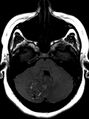 Cerebellar hemangioblastoma (Radiopaedia 10779-11234 Axial T1 1).JPG