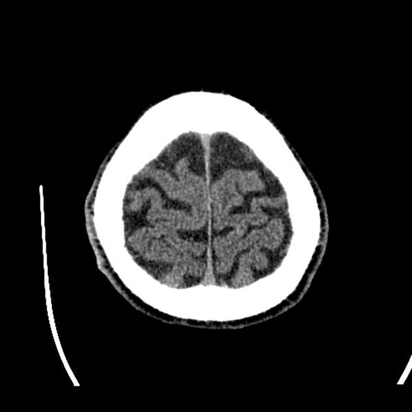 File:Cerebellar hemorrhage (Radiopaedia 27193-27359 Axial non-contrast 49).jpg