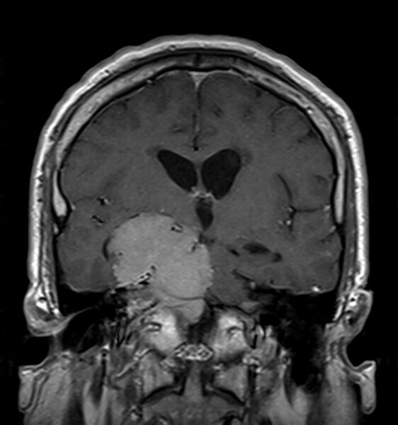 File:Cerebellopontine angle meningioma (Radiopaedia 24459-24764 Coronal T1 C+ 11).jpg