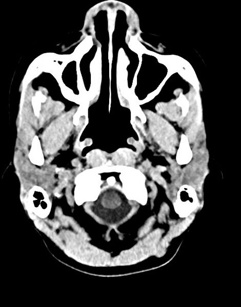 File:Cerebral abscesses (Radiopaedia 70458-80568 Axial non-contrast 10).jpg