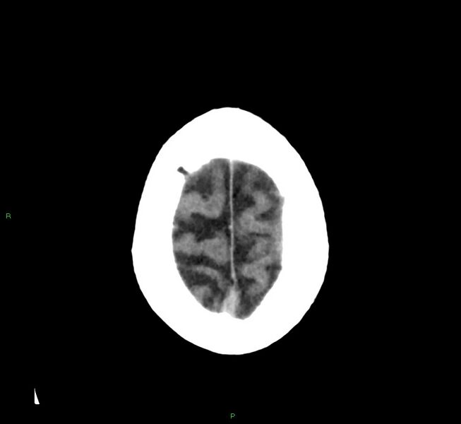 File:Cerebral amyloid angiopathy-associated lobar intracerebral hemorrhage (Radiopaedia 58376-65511 Axial non-contrast 9).jpg