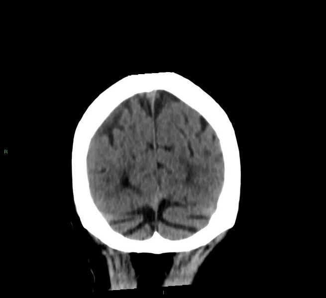 File:Cerebral amyloid angiopathy-associated lobar intracerebral hemorrhage (Radiopaedia 58376-65513 Coronal non-contrast 23).jpg