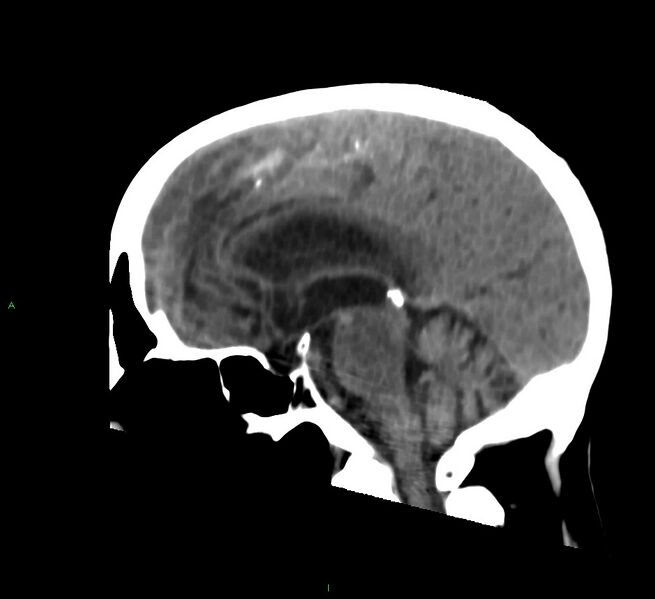 File:Cerebral amyloid angiopathy-associated lobar intracerebral hemorrhage (Radiopaedia 58530-65688 C 27).jpg