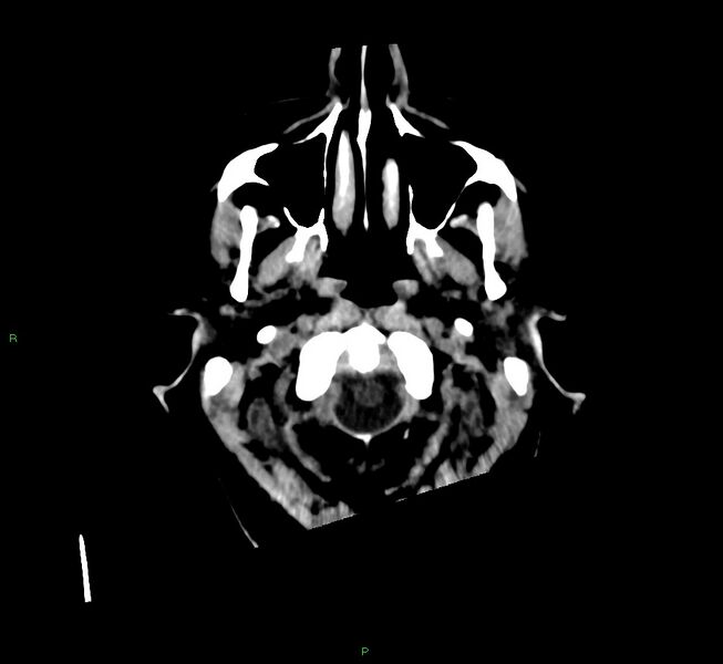 File:Cerebral amyloid angiopathy-associated lobar intracerebral hemorrhage (Radiopaedia 58560-65723 Axial non-contrast 50).jpg
