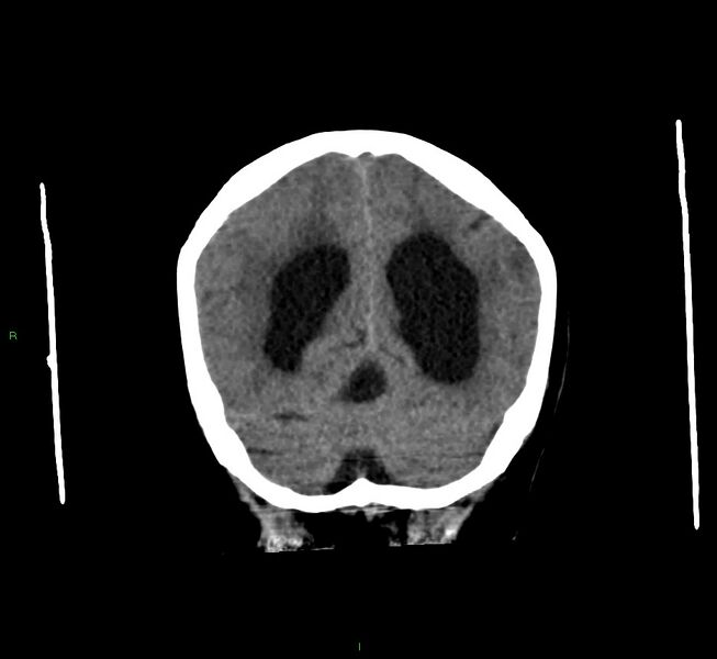 File:Cerebral amyloid angiopathy-associated lobar intracerebral hemorrhage (Radiopaedia 58560-65723 Coronal non-contrast 20).jpg
