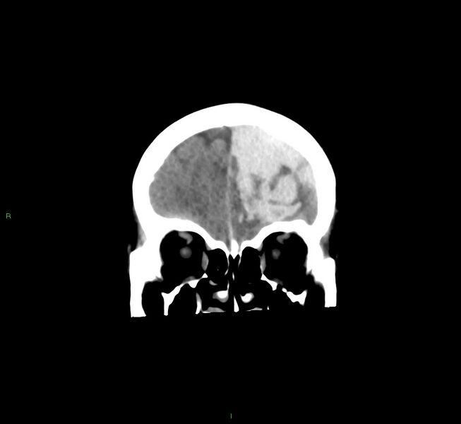 File:Cerebral amyloid angiopathy-associated lobar intracerebral hemorrhage (Radiopaedia 58561-65724 Coronal non-contrast 50).jpg