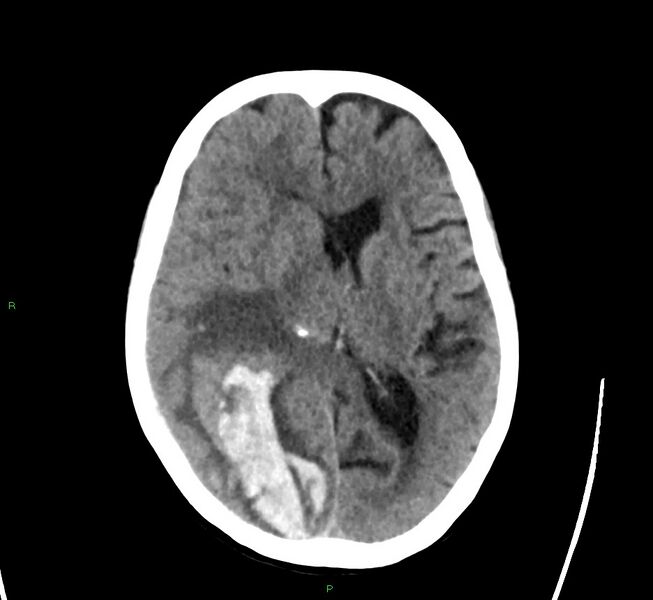 File:Cerebral amyloid angiopathy-associated lobar intracerebral hemorrhage (Radiopaedia 58563-65727 Axial non-contrast 27).jpg