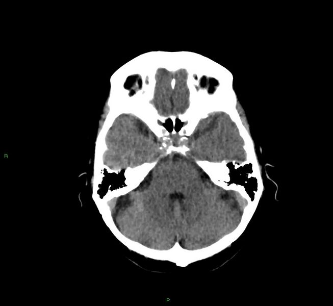 File:Cerebral amyloid angiopathy-associated lobar intracerebral hemorrhage (Radiopaedia 58757-65978 Axial non-contrast 37).jpg