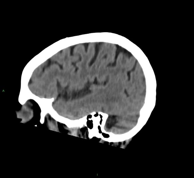 File:Cerebral amyloid angiopathy-associated lobar intracerebral hemorrhage (Radiopaedia 58757-65978 C 14).jpg