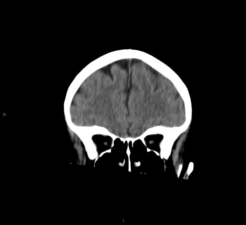 Cerebral amyloid angiopathy-associated lobar intracerebral hemorrhage (Radiopaedia 58757-65978 Coronal non-contrast 51).jpg