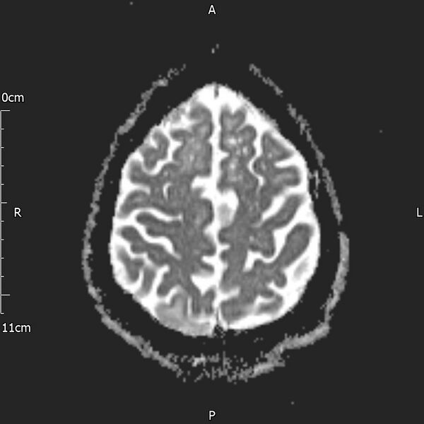 File:Cerebral amyloid angiopathy related inflammation (Radiopaedia 72772-83415 Axial ADC 19).jpg